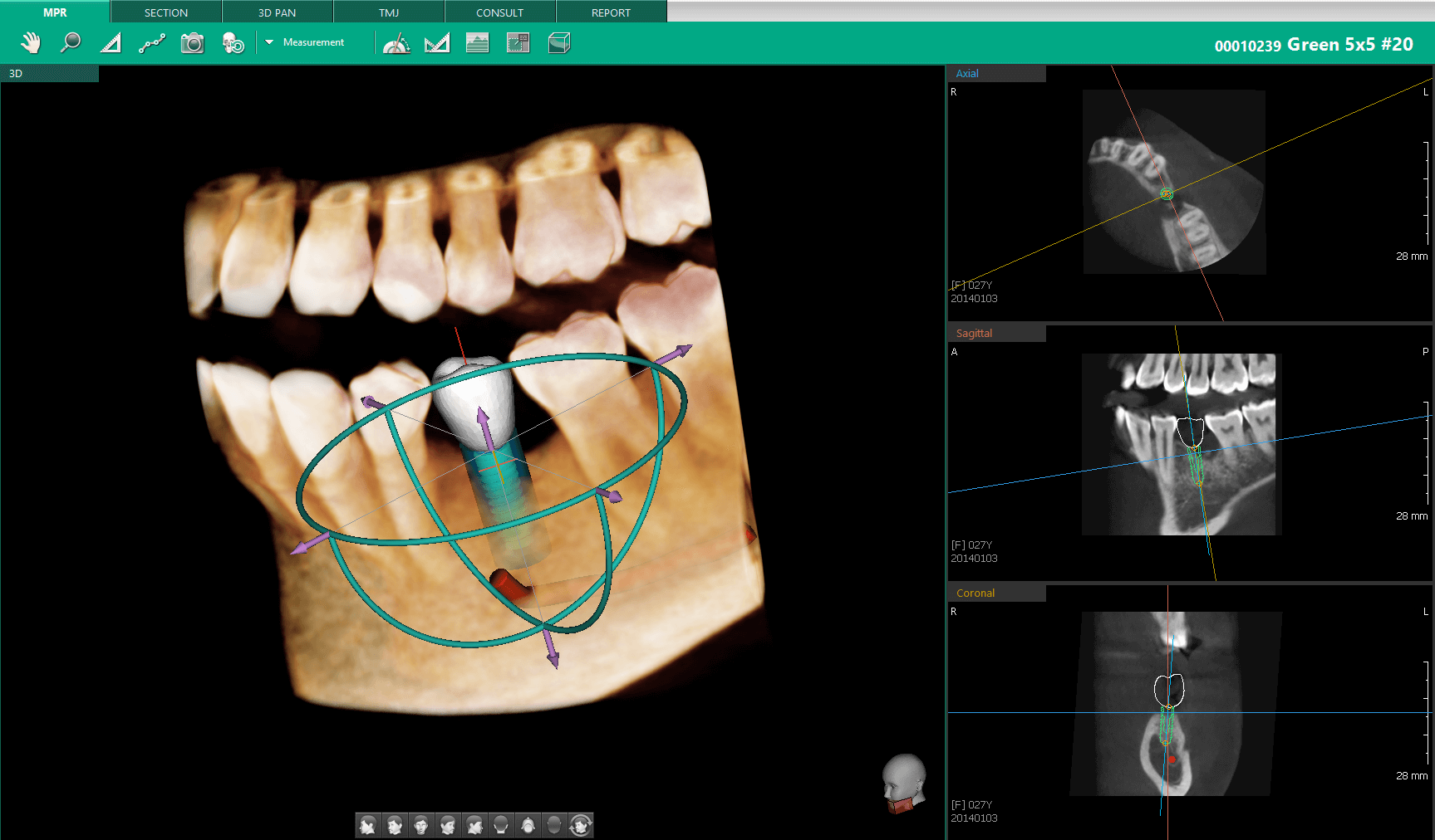 3D dental scan showing teeth model with implant planning and X-ray images for treatment analysis.