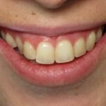 Close-up of a person's smile showing teeth with visible discoloration and spacing irregularities.