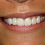 Close-up of a person's bright, white smile showing healthy teeth and natural complexion.