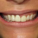 Close-up of a person's smile showing teeth and lips in a dental context.
