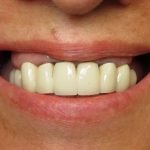 Close-up of person's smile displaying white dental crowns and natural teeth alignment.