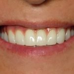 Close-up of a person's smile displaying bright, healthy white teeth and natural gum line.