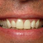 Close-up of male patient's smile displaying natural teeth and gum line for dental evaluation.