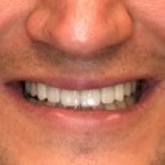 Close-up of person's smile showing teeth and gum line in dental care context.