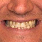 Close-up of person's smile showing teeth with visible discoloration and spacing issues.