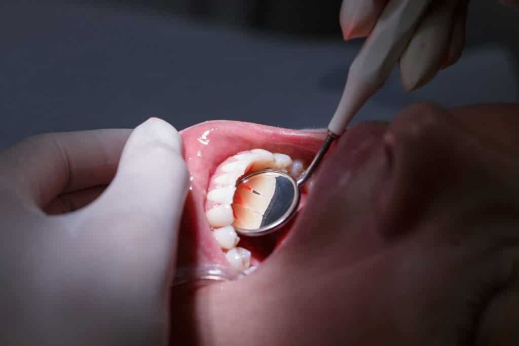 Plaque and Tartar - Identifying the Difference and Methods of Prevention