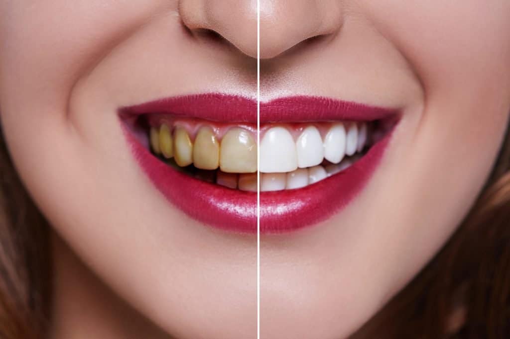 Should I Get Veneers? Determining the Best Candidates