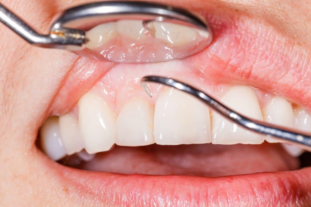 Identifying Early Signs of Gum Disease and What to do About It