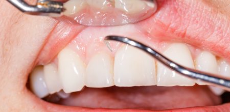 Identifying Early Signs of Gum Disease and What to do About It