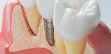 What are Dental Implants and How do I Choose the Best Dentist for Them?