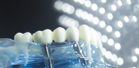 Are Dental Implants Safe? Here’s What You Need to Know