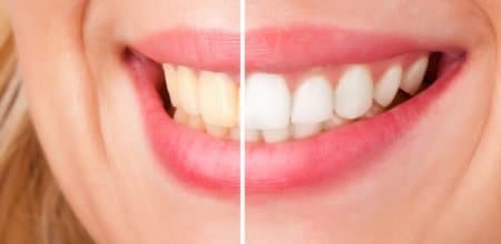 Who’s a Good Candidate for Professional Teeth Whitening?