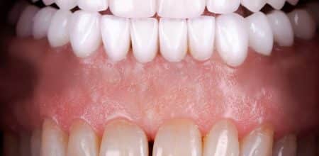 Revitalize Your Smile: Veneers in Jupiter, FL