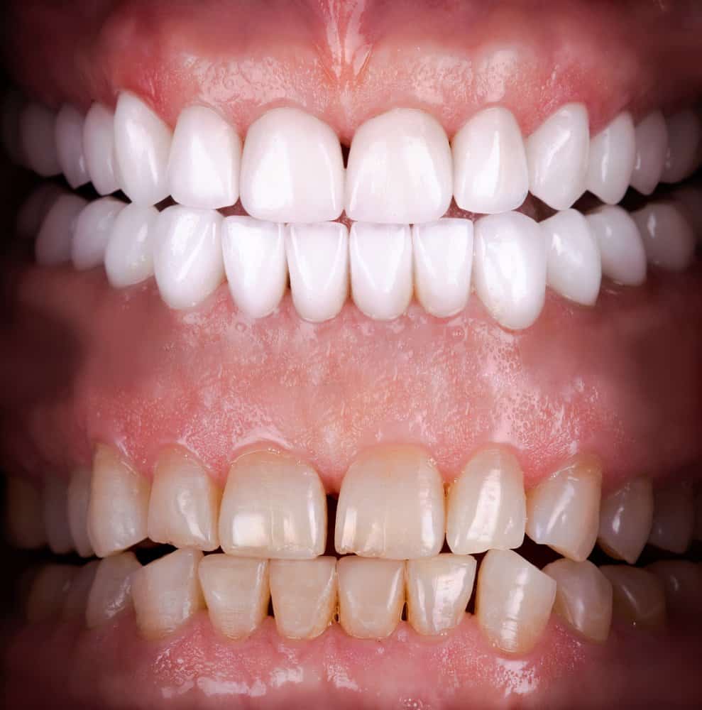 What are Dental Veneers? Uses, Treatment Process, and Care