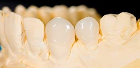 Addressing the Most Common Myths About Dental Veneers