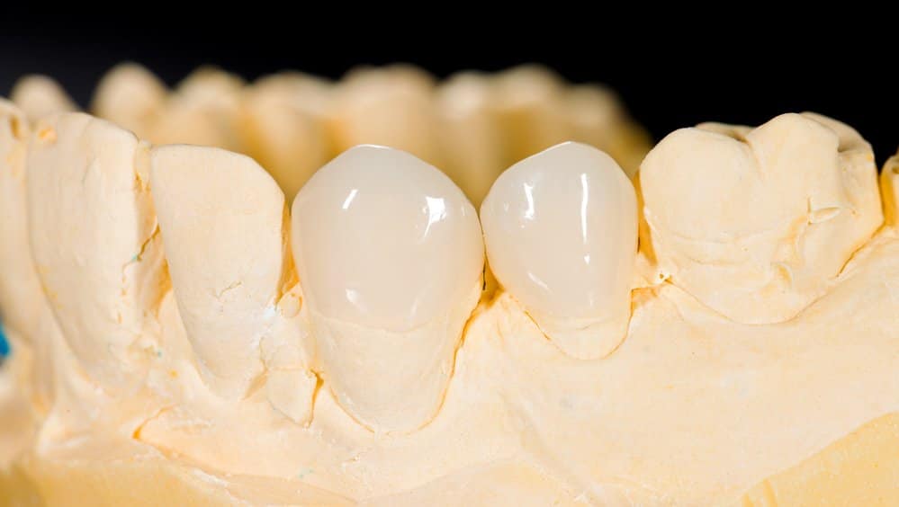 Addressing the Most Common Myths About Dental Veneers