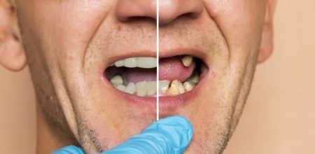 What to Expect Before and After Dental Implants
