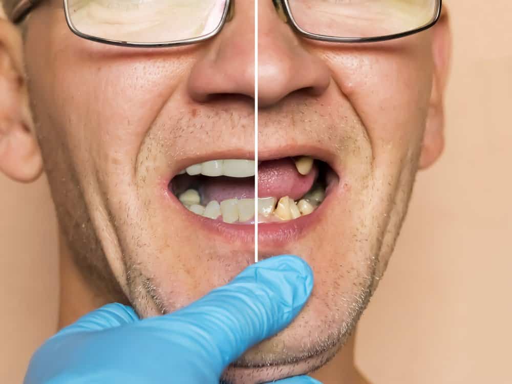What to Expect Before and After Dental Implants