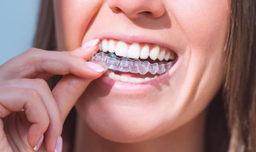 "Patient visits at Riverbend Family Dentistry at Jupiter for Invisalign Treatment."