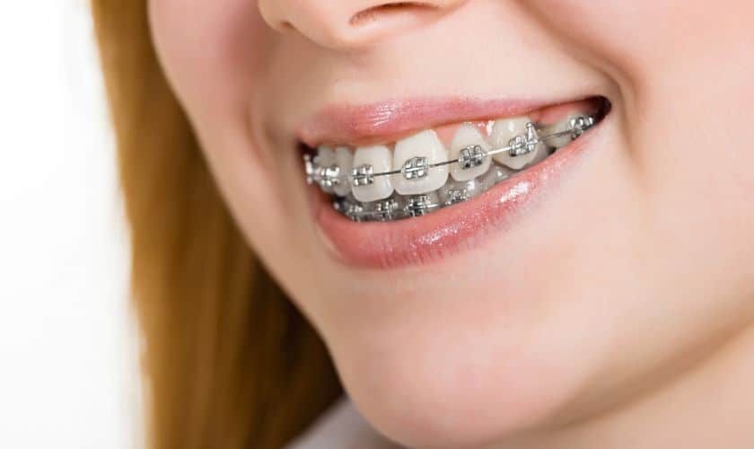 "Patient visits at Riverbend Family Dentistry in Jupiter for Orthodontist Treatment."