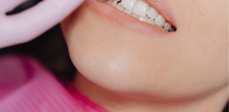 Icon White Spot Treatment: Your Smile’s Best Friend