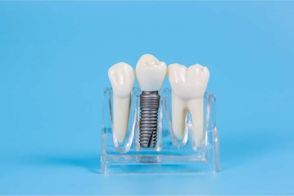 Plastic dental implants