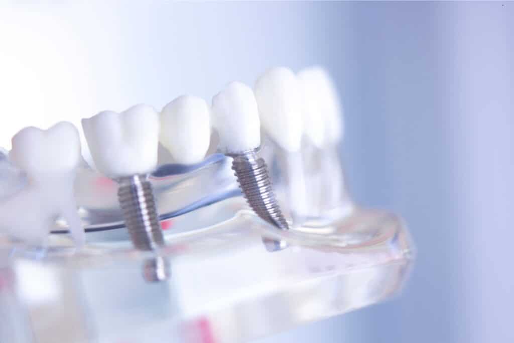 Sedation Options for Dental Implants in Jupiter FL