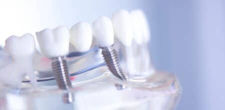 Optimal Sedation Options for Dental Implants: What You Need to Know