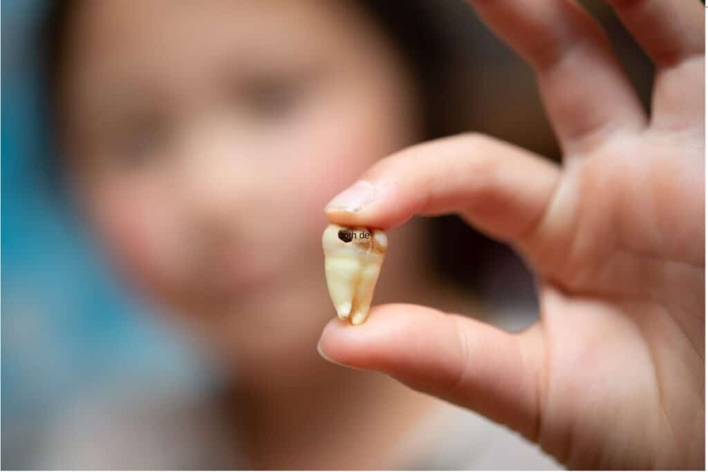 Tooth Decay concept by Riverbend Family Dentistry Jupiter Florida