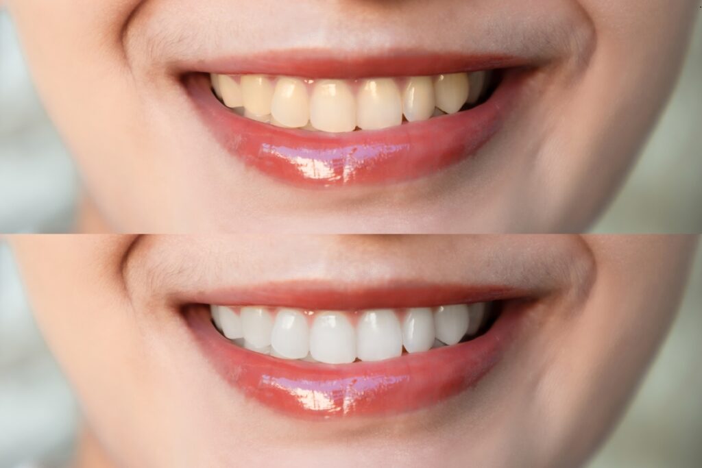 Teeth Whitening at Riverbend Family Dentistry Jupiter, FL
