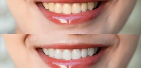 Is Teeth Whitening Safe? Your Comprehensive Guide to a Brighter Smile