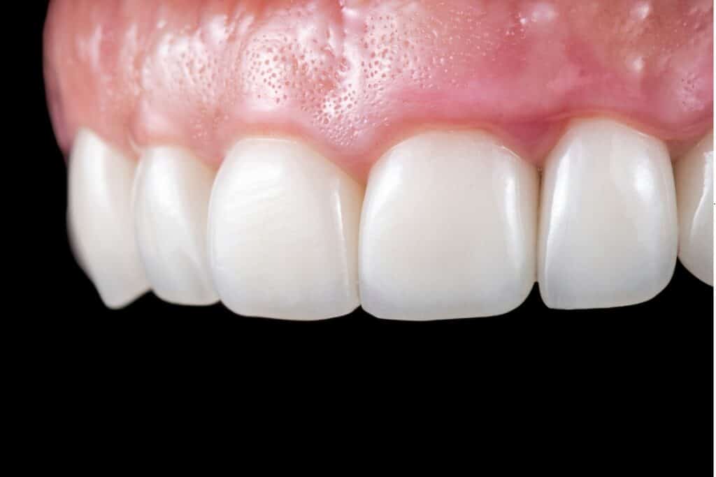 Cosmetic dentist Jupiter | Dental Veneers Jupiter Fl