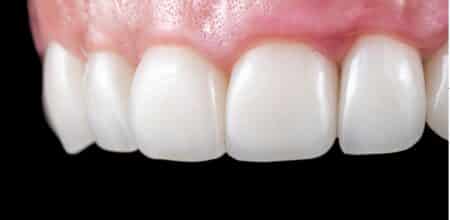 How Long Do Dental Veneers Last? Everything Jupiter Patients Need to Know