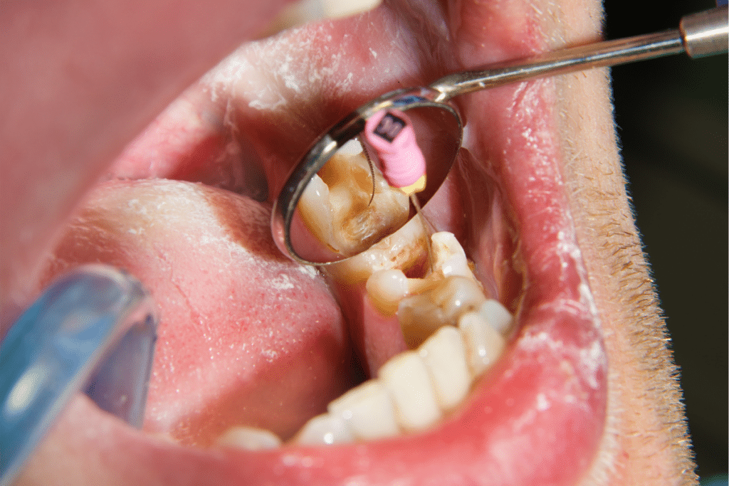 Root Canal Recovery Tips in Jupiter