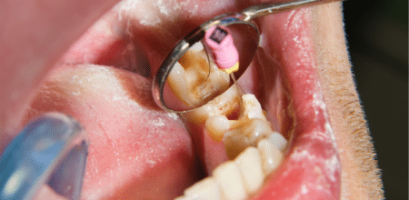 Essential Root Canal Recovery Tips to Heal Faster and Comfortably