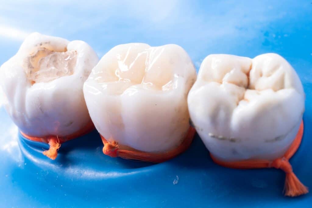 Dental Fillings Jupiter FL