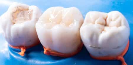 Protecting Your Investment: A Local Guide to Maintaining a Strong, Healthy Smile