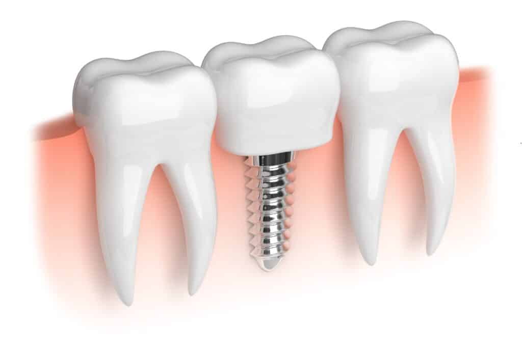 Dental implant illustration showing three teeth with screw implant between natural teeth.