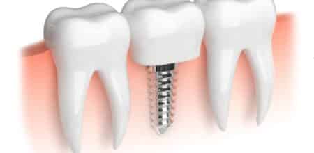 Dental implants: common problems and solutions