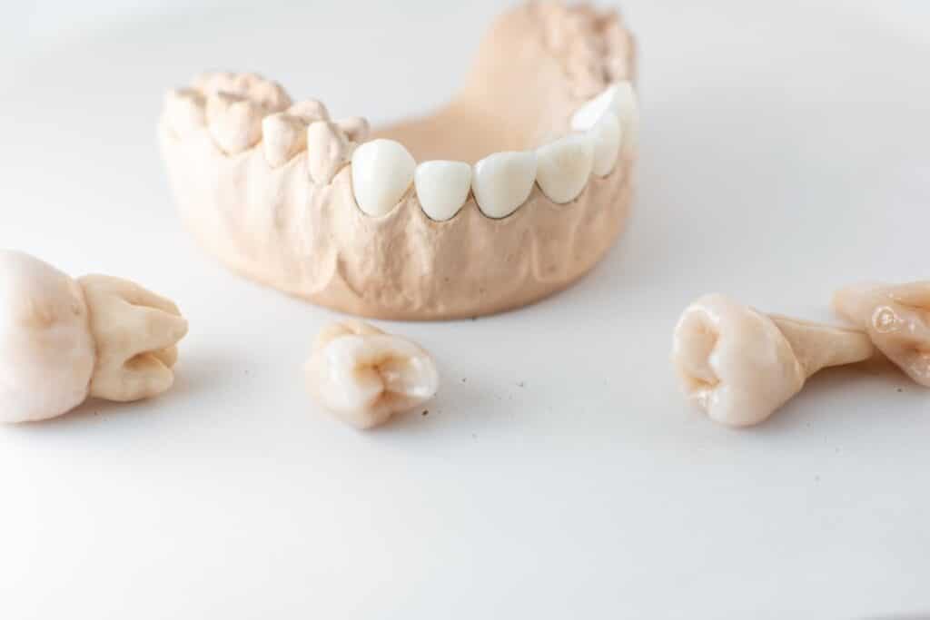 Cosmetic Crown by Riverbend Dental Jupiter FL