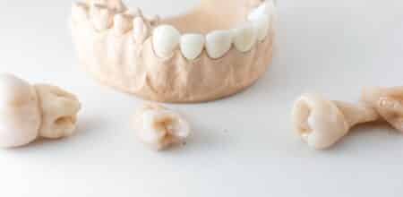 How to Care for Your Cosmetic Crown: Tips for Longevity