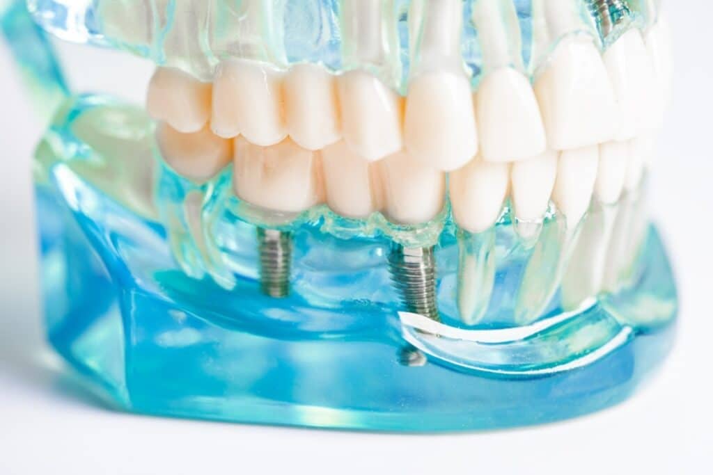Dental Implants Jupiter