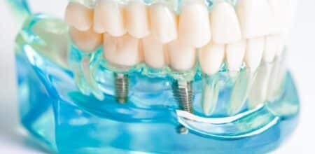 Essential Questions to Ask Before Getting Dental Implants