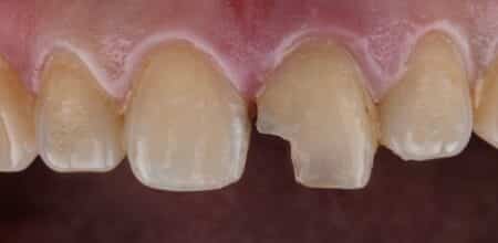 How to Identify When a Chipped Tooth Becomes a Dental Emergency