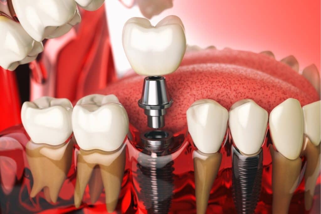 Dental Implants Jupiter FL