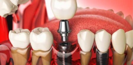 How Nutrition Affects the Healing and Longevity of Dental Implants