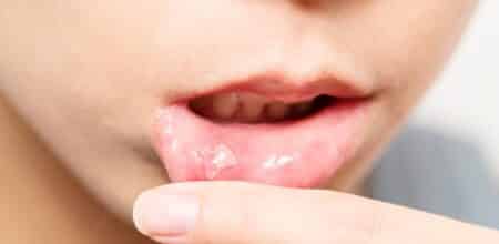 Banish Oral Ulcers: Proven Treatments for Mouth, Lip, and Dental Sores
