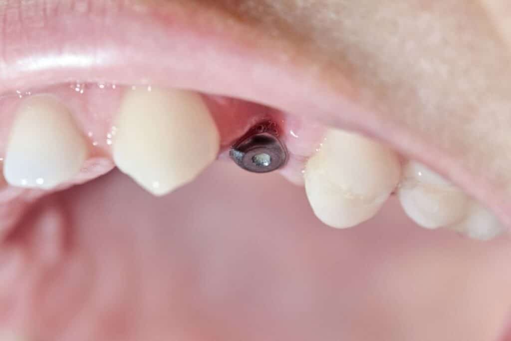 Dental Implants by Riverbend Family Dentistry Jupiter