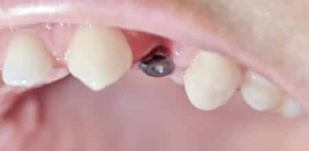 Is a Metallic Taste Common After Dental Implant Surgery?