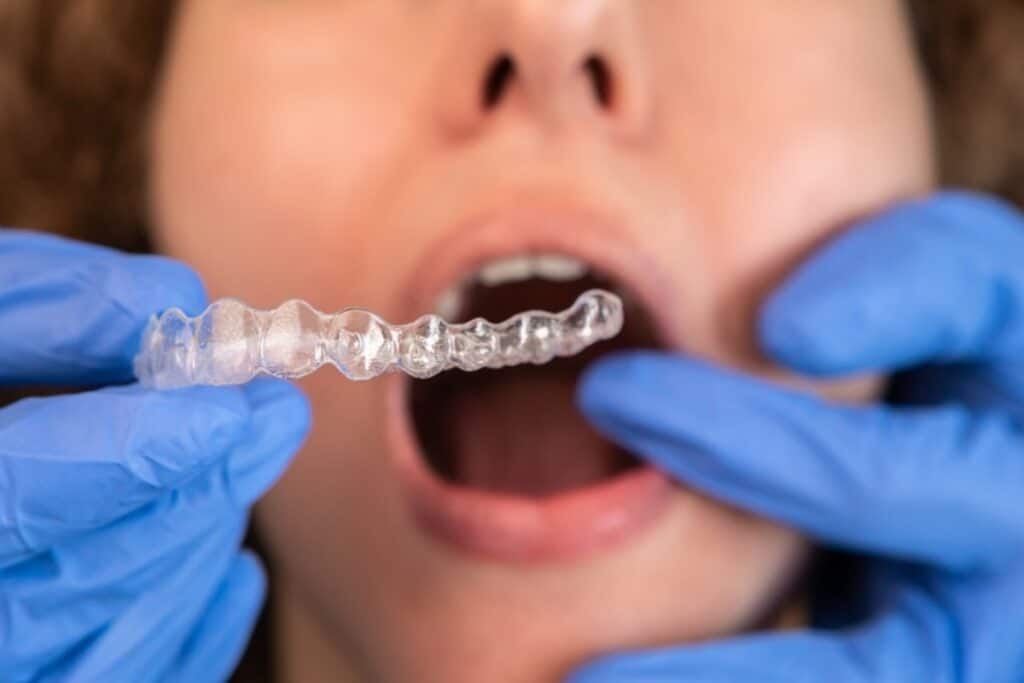 Underbite treatment by Invisalign